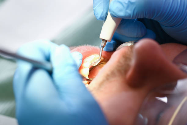 Best Emergency Dental Care for Sports Injuries in North Terre Haute, IN